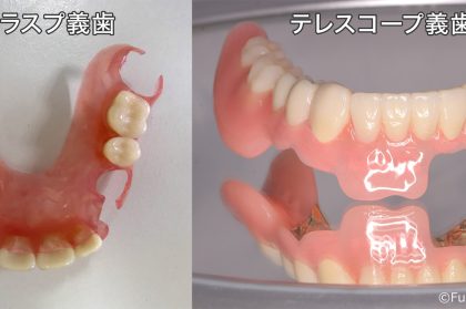 ノンクラスプ義歯(柔らかい入れ歯)とテレスコープ義歯 どちらを選んで良いか迷っているあなたに