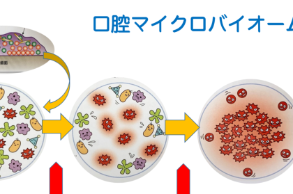 歯のクリーニング、ただのお掃除じゃないんです ~マイクロバイアルシフトへの対策としてのクリーニング~